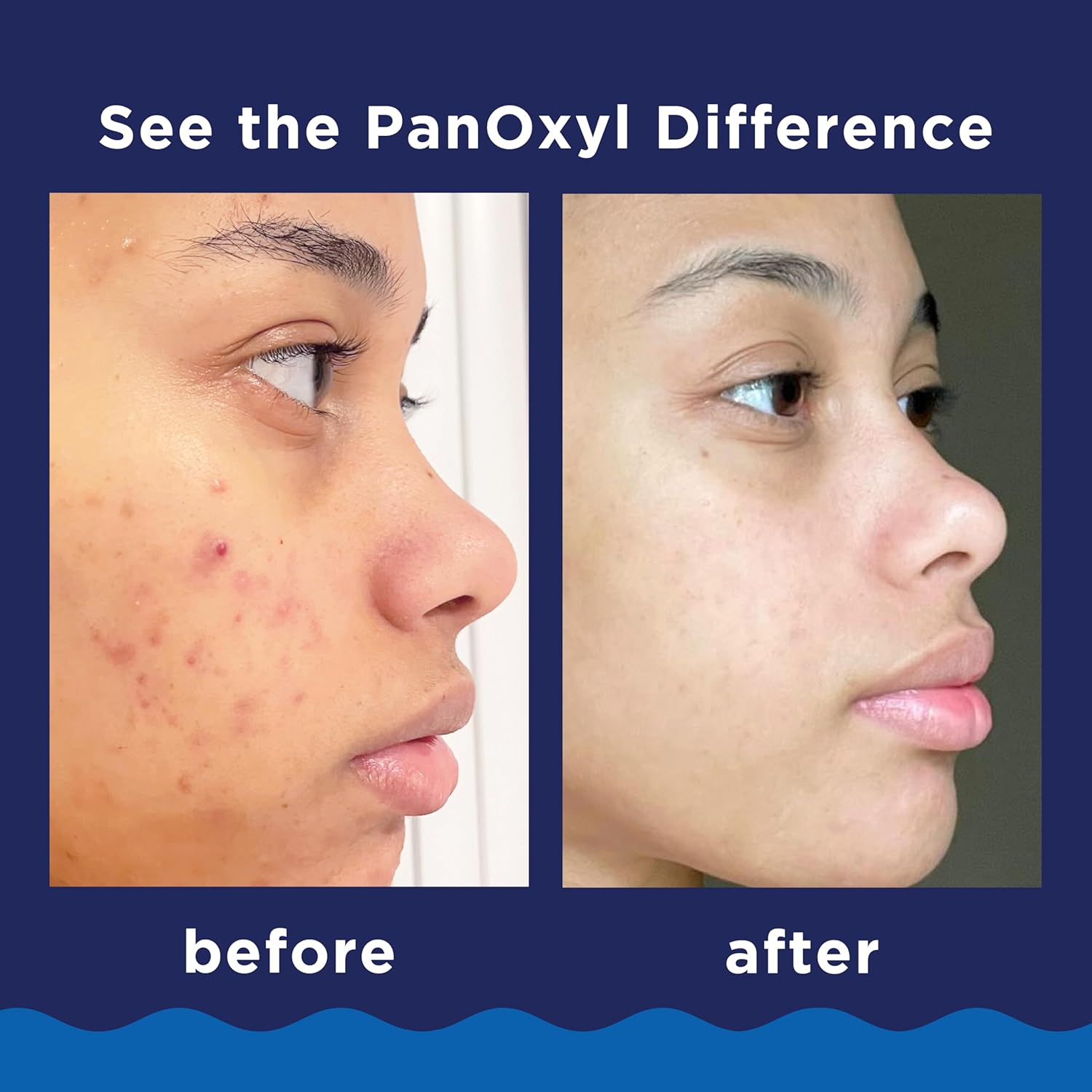 PANOXYL ACNE FOAMING WASH BENZOYL PEROXIDE 10% MAXIMUM STRENGHT 156 G