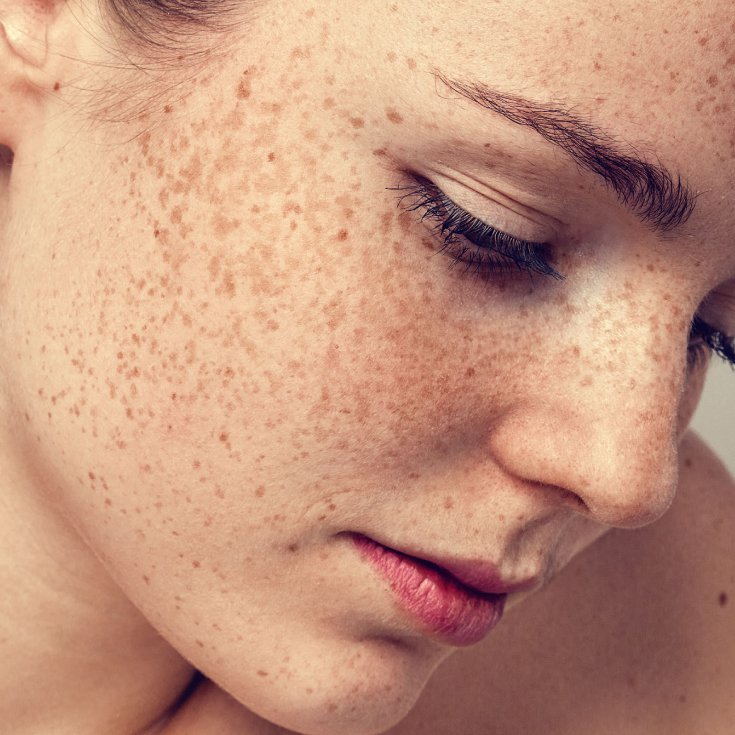 HYPERPIGMENTATION