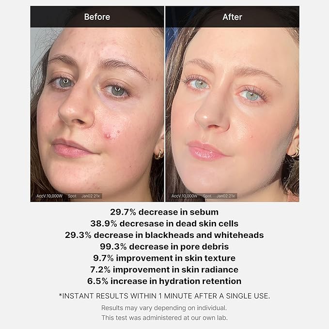 MEDICUBE 1 MINUTE RED ACNE SUCCINIC ACID PEEL 40 G