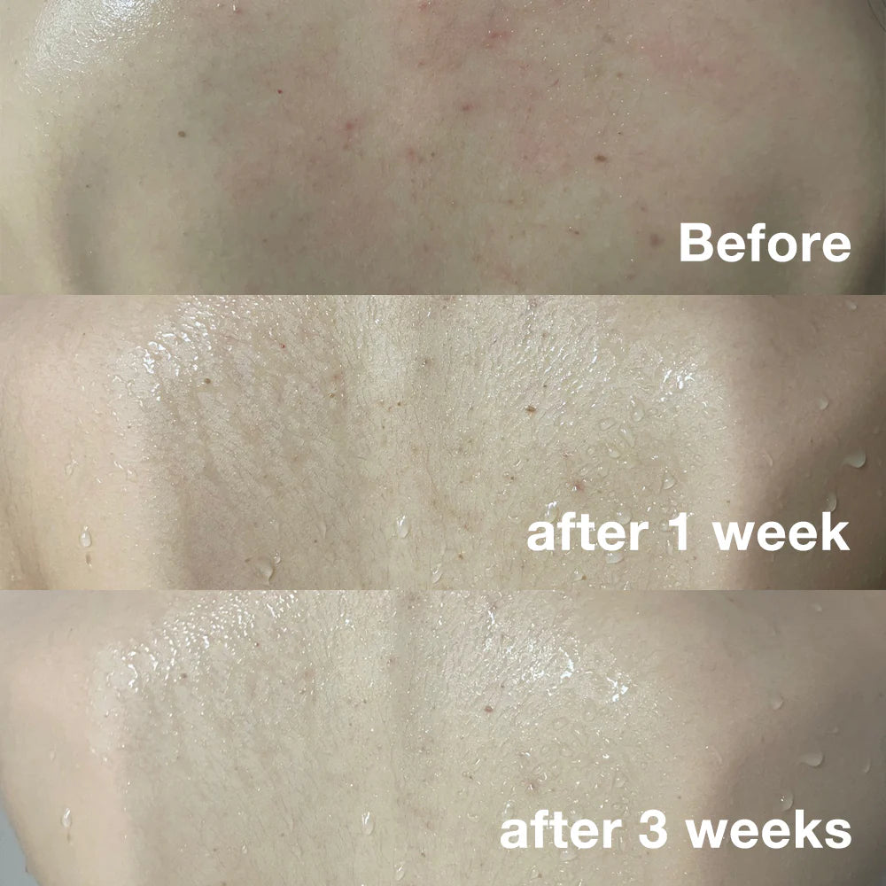 MEDICUBE RED ACNE BODY WASH AHA BHA PHA NIACINAMIDE 400G