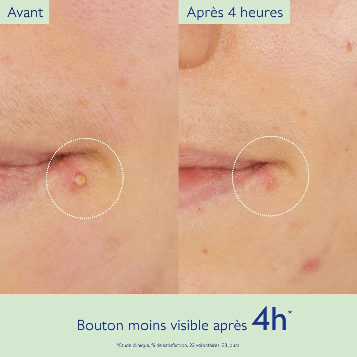 CAUDALIE VINOPURE STOP BOUTONS SALICYLIQUR 15ML